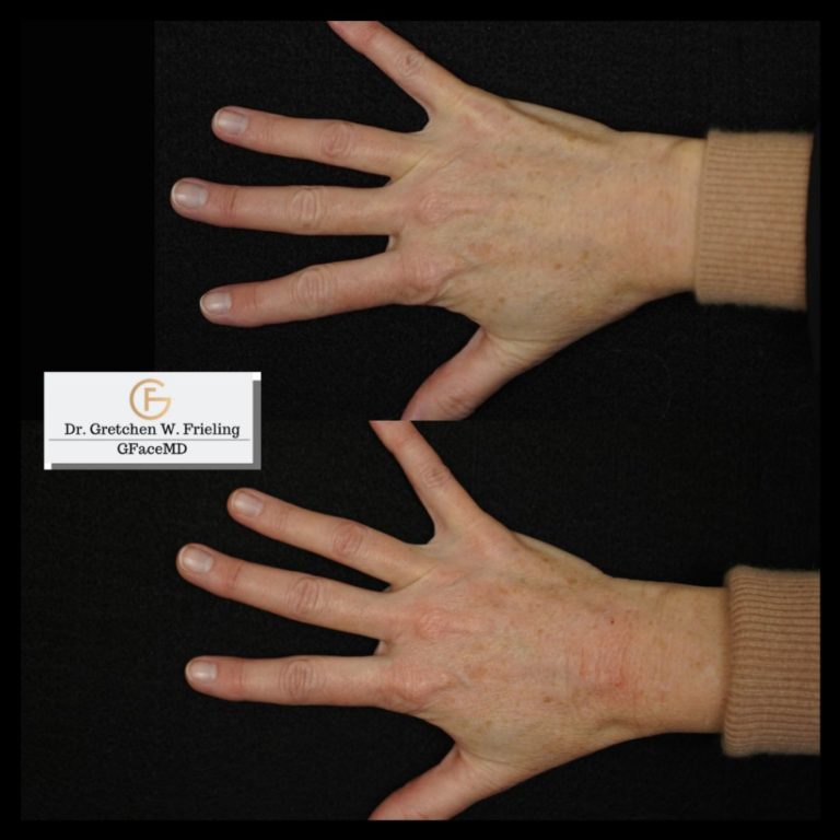 HANDS