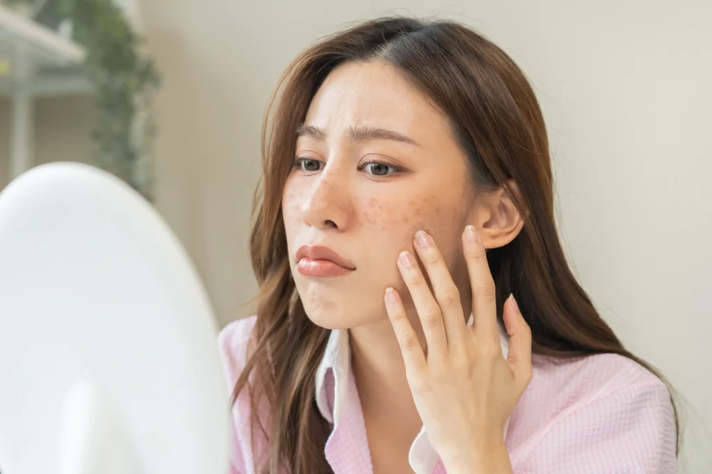 Understanding Melasma and How to Treat It: A Comprehensive Guide 1 Understanding Melasma and How to Treat It: A Comprehensive Guide