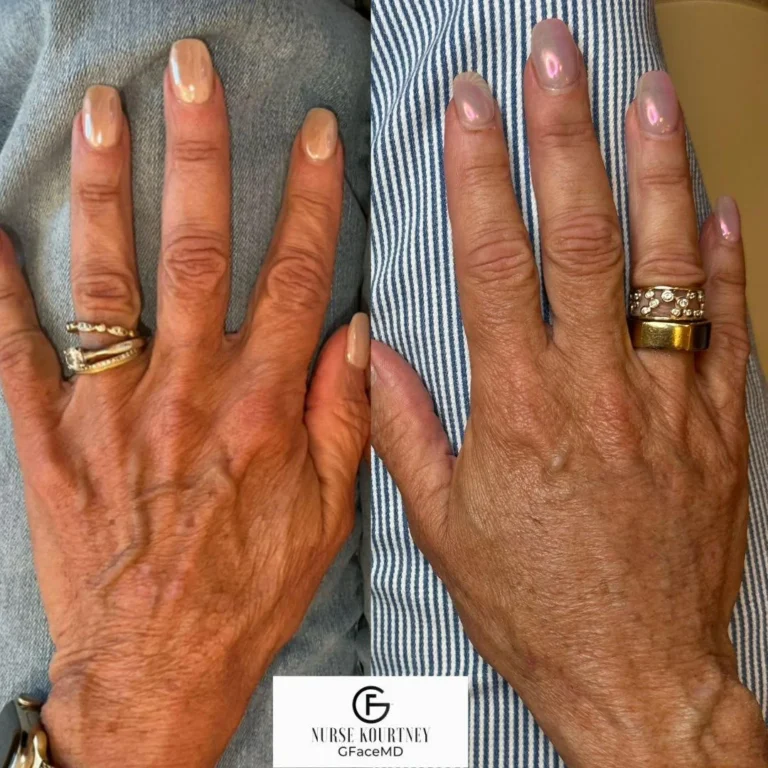 hand rejuvenation treatment