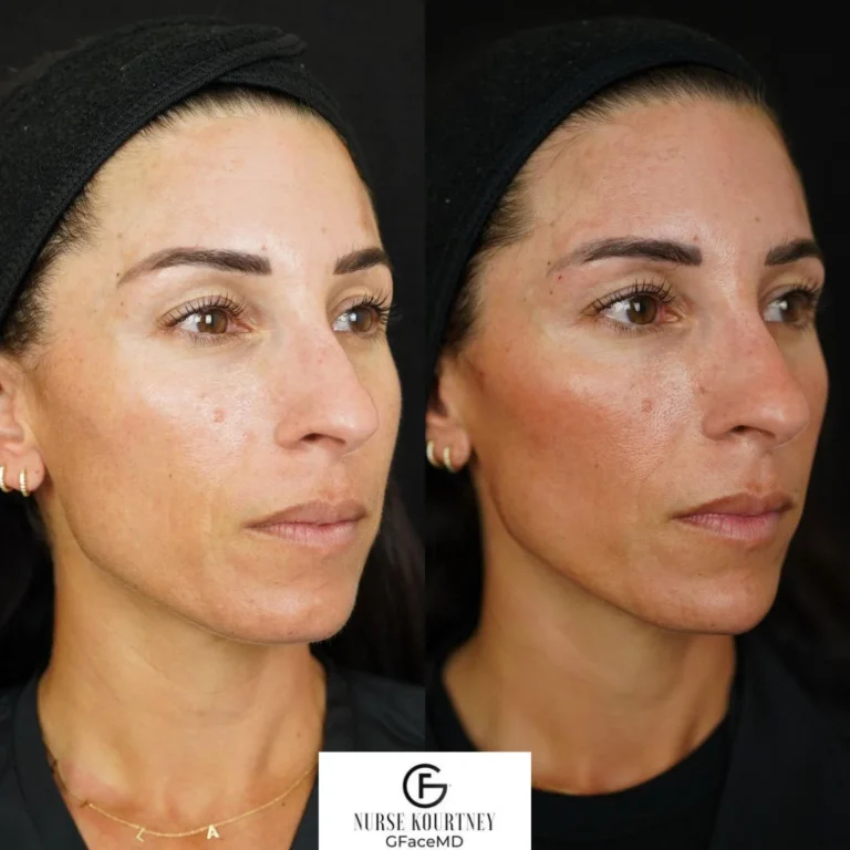Lip Filler Treatment