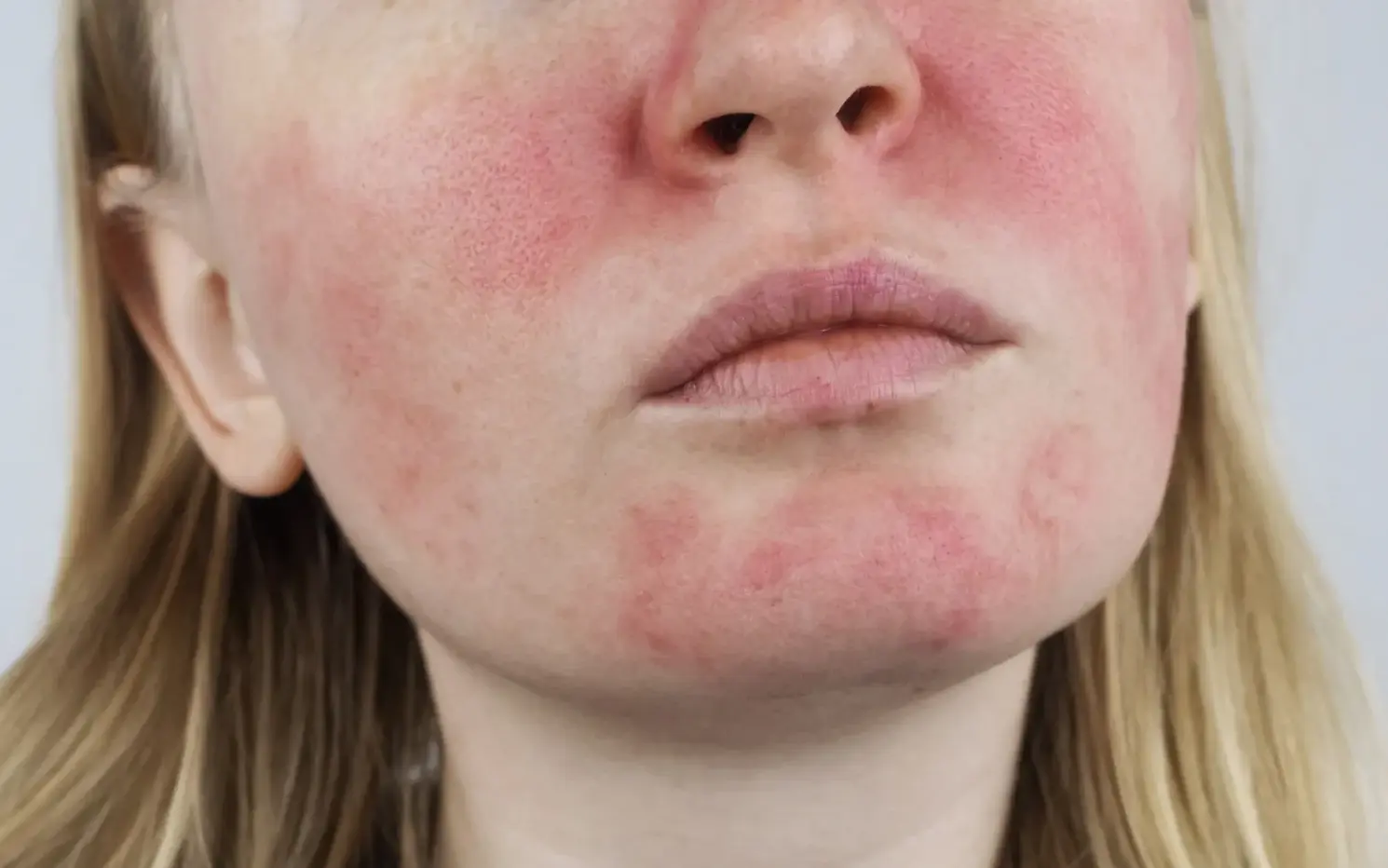 Blog 10 The Red Flag: Understanding Skin Redness and Product Effectiveness