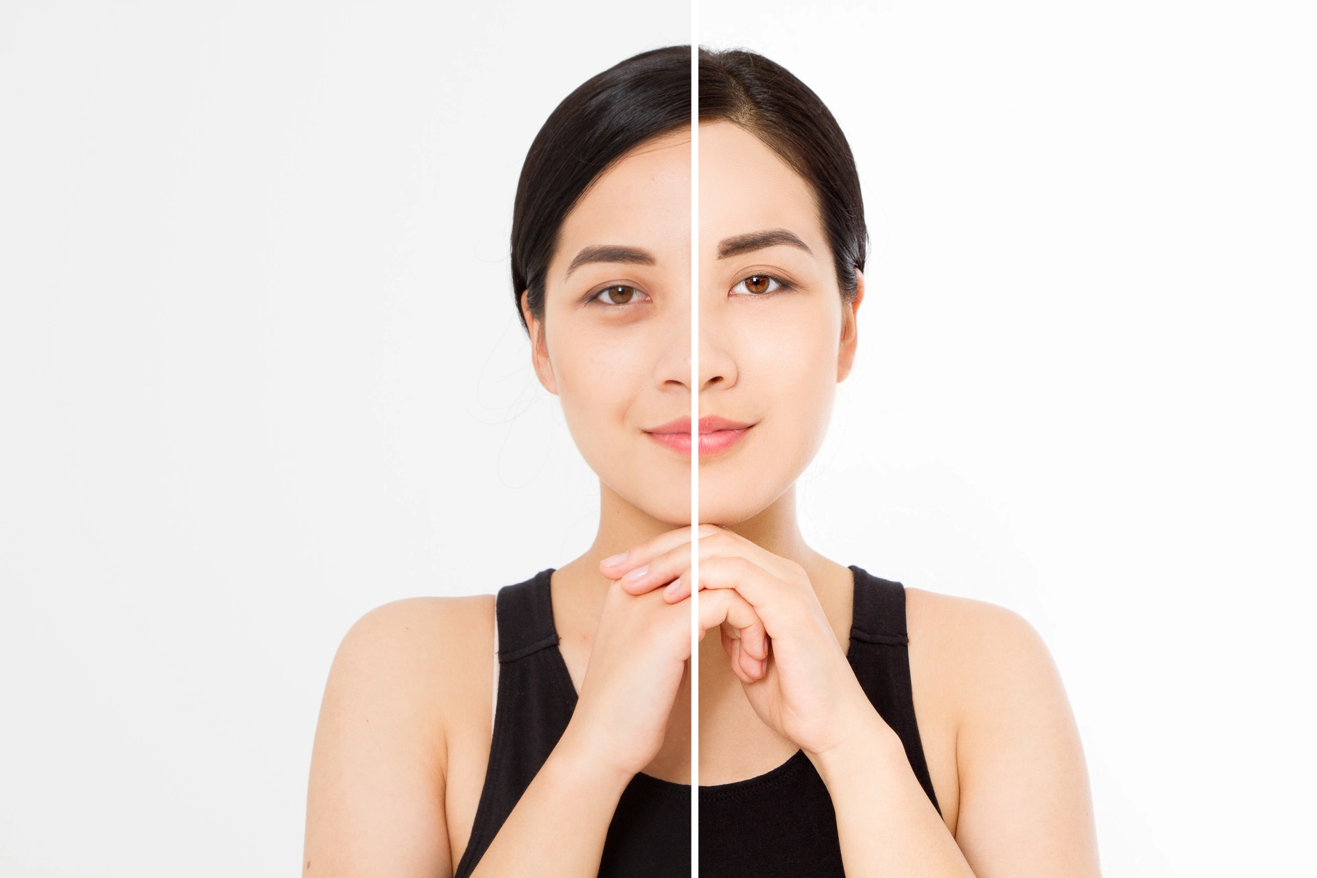 Blog 2 Woman showing before and after improvement in under-eye hollows
